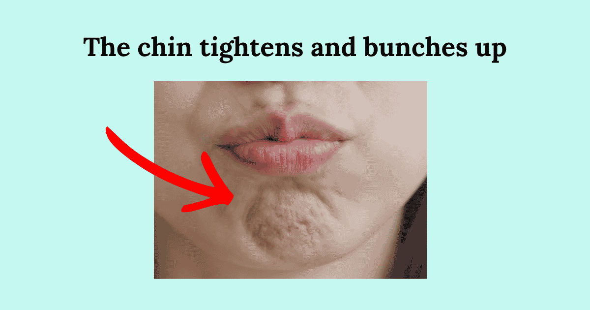 A bunched chin: the chin tightens and bunches up
